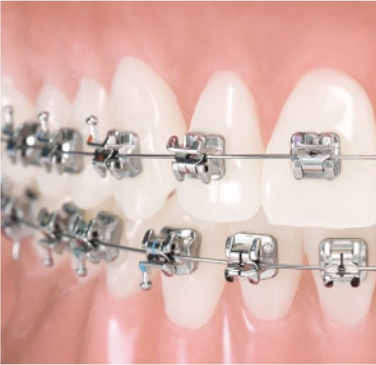 Urgence en orthodontie multi attache metalique